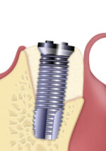 Gen-Os granulato mix 1000-2000 flacone da 2,0 gr. Osteobiol TGED20 - immagine 3