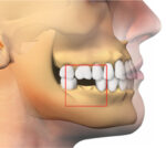 MP3 siringa da 0,5 cc. Osteobiol TMP05 - immagine 4