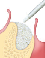 MP3 siringa da 0,5 cc. Osteobiol TMP05 - immagine 3