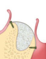 MP3 siringa da 0,5 cc. Osteobiol TMP05 - immagine 2