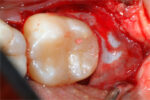 Membrana Evolution essiccata STD ovale mm 25X35 Osteobiol - immagine 2