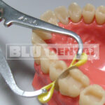 Cunei elastici kit TDV - immagine 2