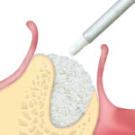 GTO sostituto osseo Osteobiol siringa 2 cc TGT20 - immagine 6