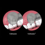 Turbina Tornado Bien Air - immagine 5